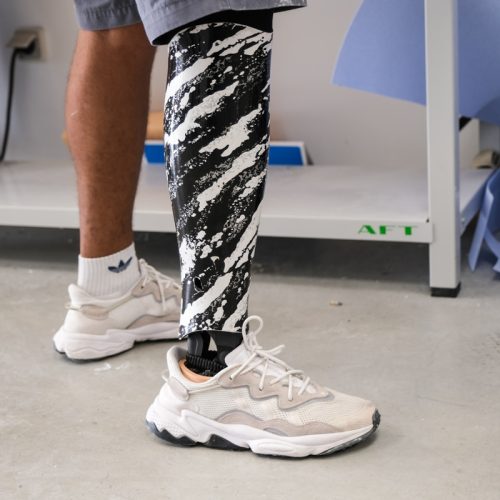 Customisation de prothèse sur-mesure : exprimez votre style sans compromis